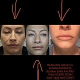 Middle is before treatment. LEFT is after Melissa insisted on dissolving filler I previously had at the cost of £170 plus £80 deposit already paid. Finally RIGHT is the photo of my lips and face AFTER Melissa injected me. They are now far too big for my f